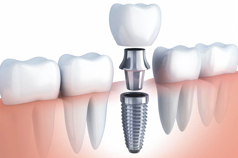 Implants Dentist in Oxnard