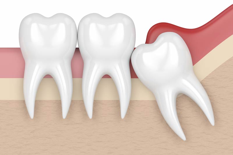 Wisdom Tooth Removal in Oxnard