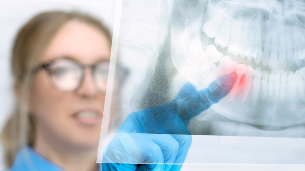 Close-up woman dentist looks at a panoramic x-ray image of a patients jaw in the dental office and points a finger at an area that will have a tooth extraction.