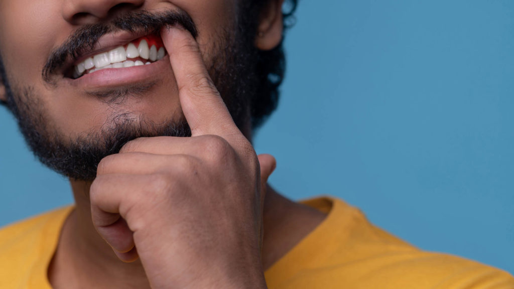 Cropped photo of a bearded mustached guy showing his gum disease and red swollen gums.