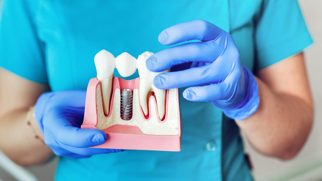 Close up of dental implants model with. hands of the dentist holding it.