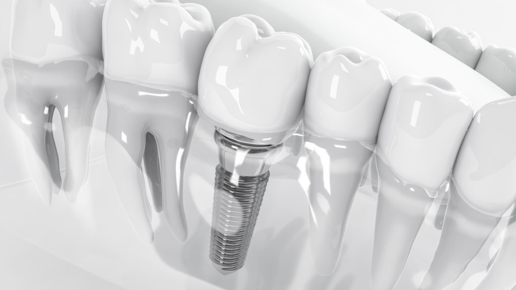 Image of a 3D rendering of a dental implant to explain the difference between veneers vs. dental implants.